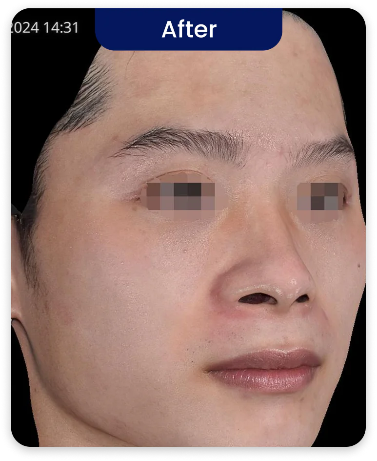After Treatment
