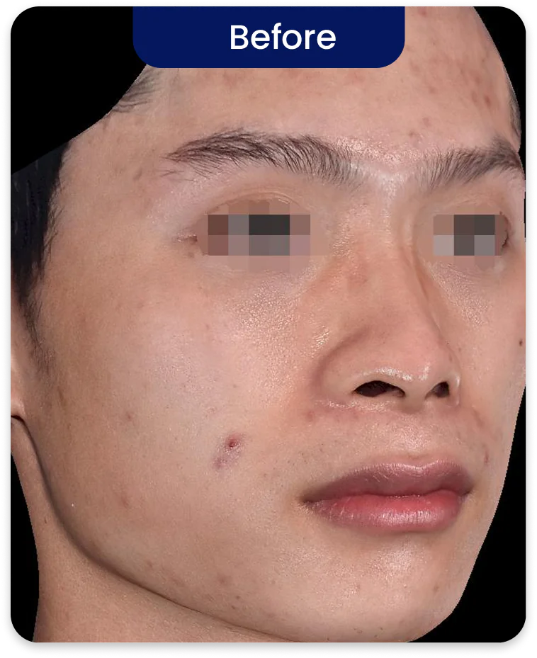 Before Treatment