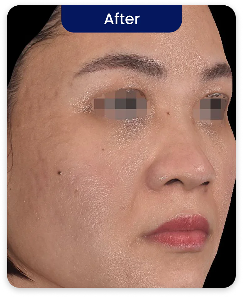 After Treatment