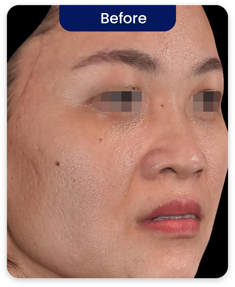 Before Treatment