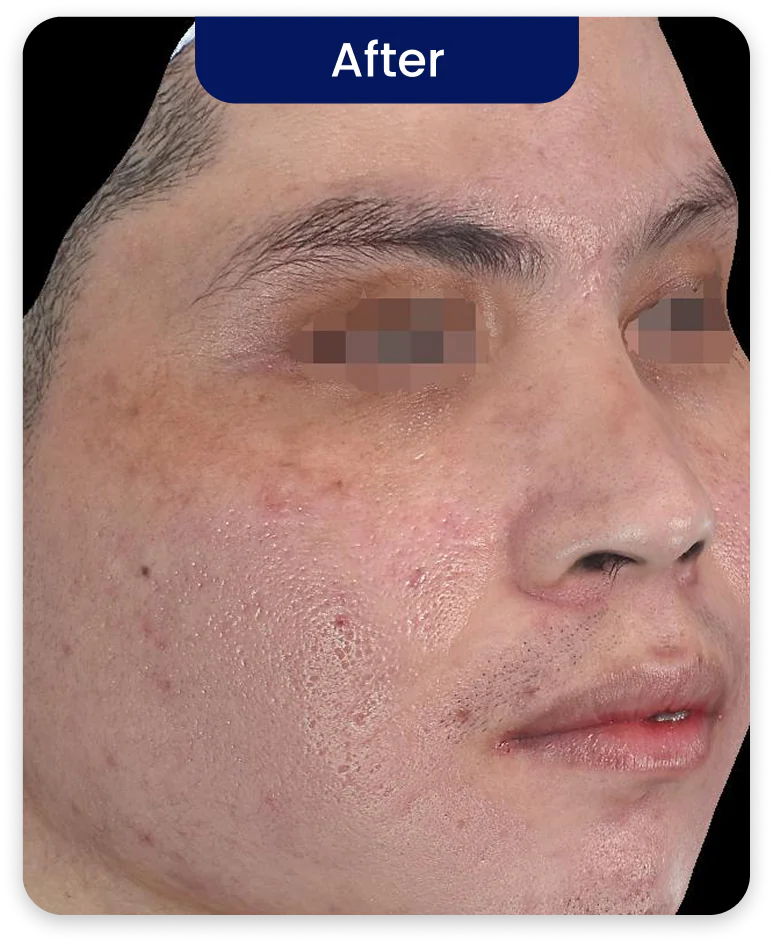 After Treatment