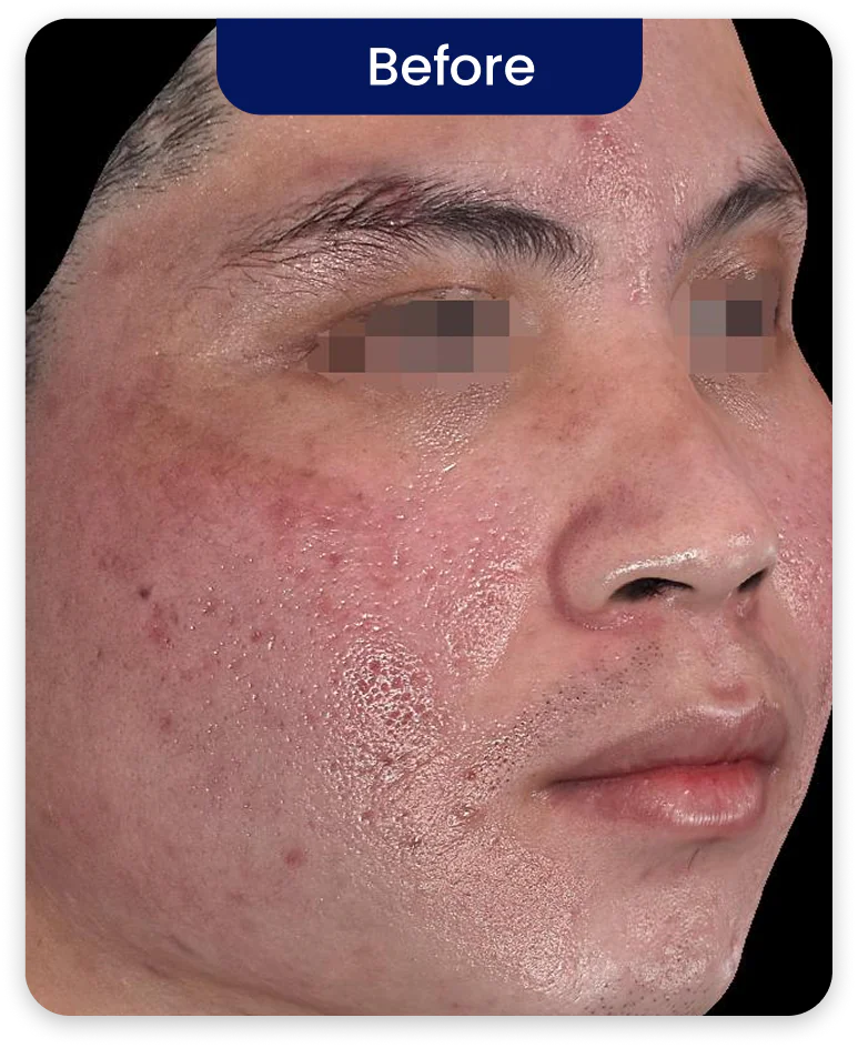 Before Treatment